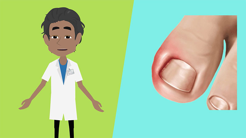 Swollen Toe Treatment